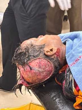 अंबाला। टोबा गांव में आवारा कुत्तों के हमले में घायल अविराज चंडीगढ़ जीएमसीएच सेक्टर-32 में उपचा