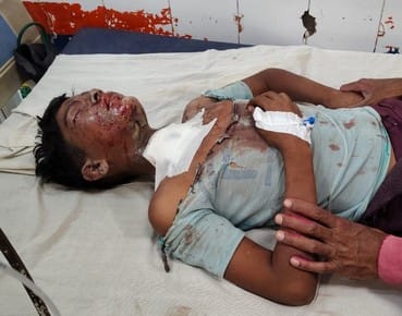 गंधक पोटास के धमाके से झुलसा बालक। स्रोत: जागरुक पाठक गंधक पोटास के धमाके से झुलसा बालक। स्रोत: जागरुक पाठक
