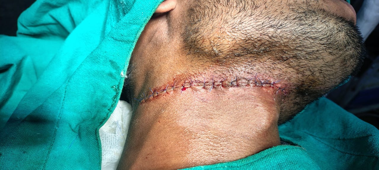 चीन के मांझा से जख्मी राजन गौतम। संवाद चीन के मांझा से जख्मी राजन गौतम। संवाद