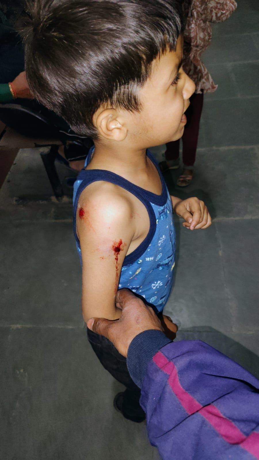 कुत्ते के हमले में जख्मी बच्चा।