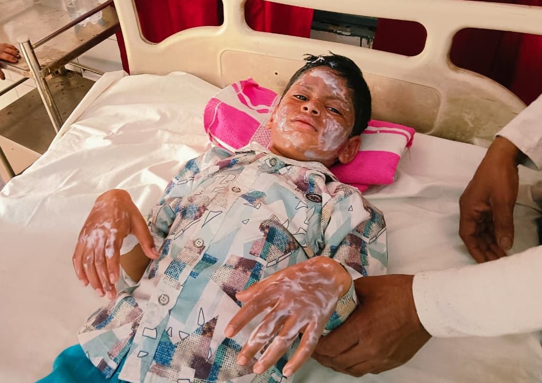 राजकीय मेडिकल कॉलेज में भर्ती आग से झुलसा अनुराग। संवाद राजकीय मेडिकल कॉलेज में भर्ती आग से झुलसा अनुराग। संवाद