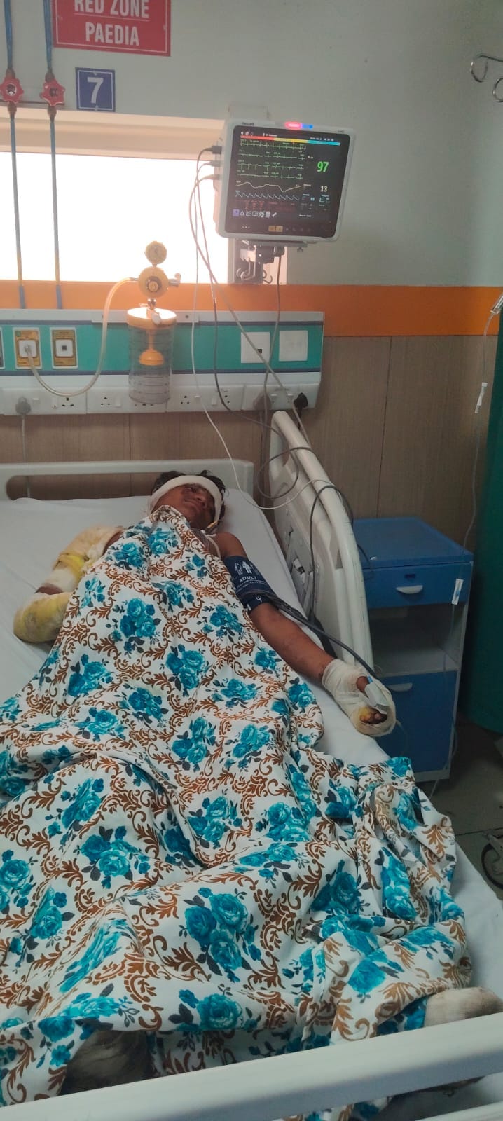 केमिकल से झुलसा किशोर। सुधी पाठक केमिकल से झुलसा किशोर। सुधी पाठक