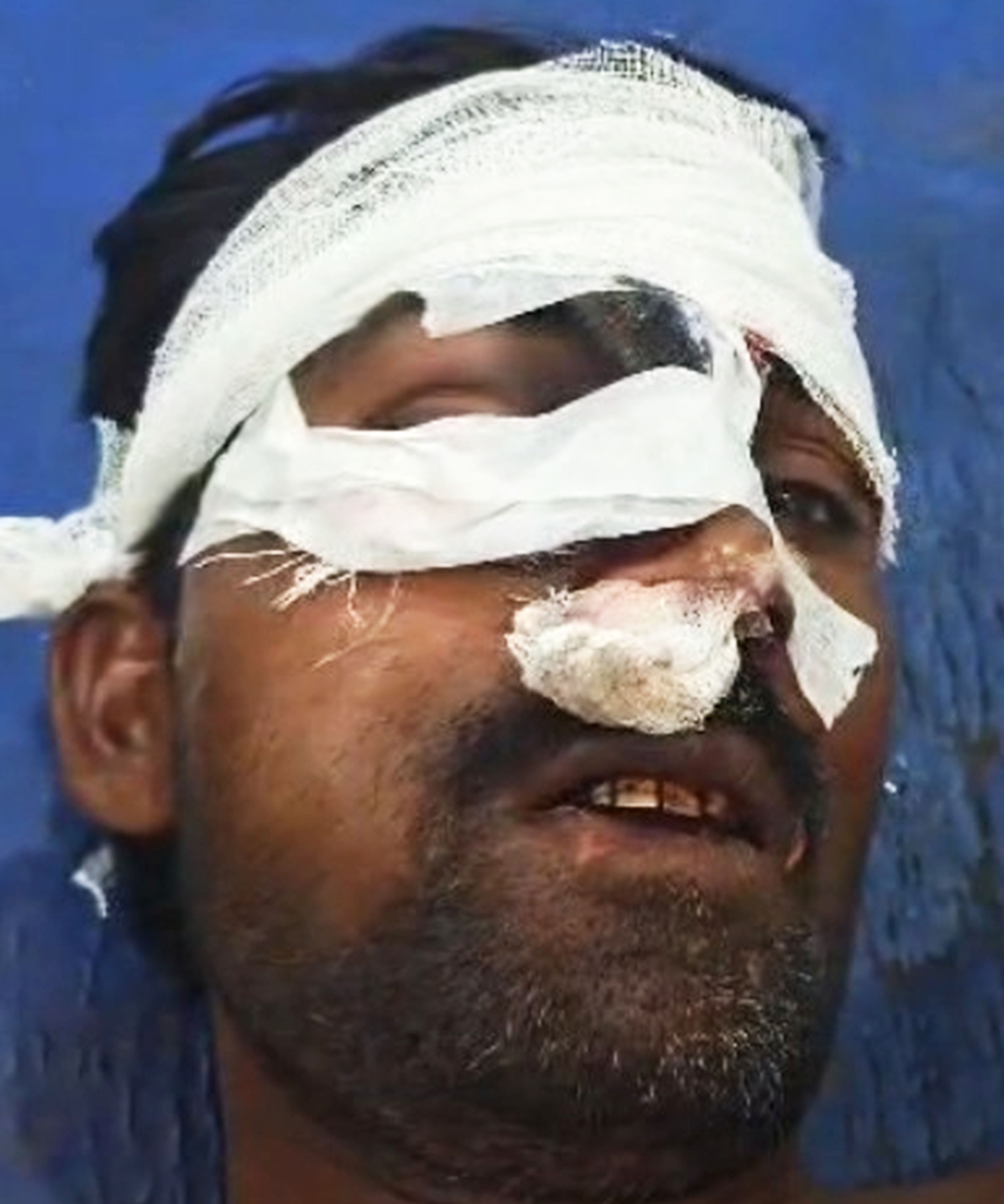 फोटो-26-कनैरी गांव में घायल ननका। संवाद