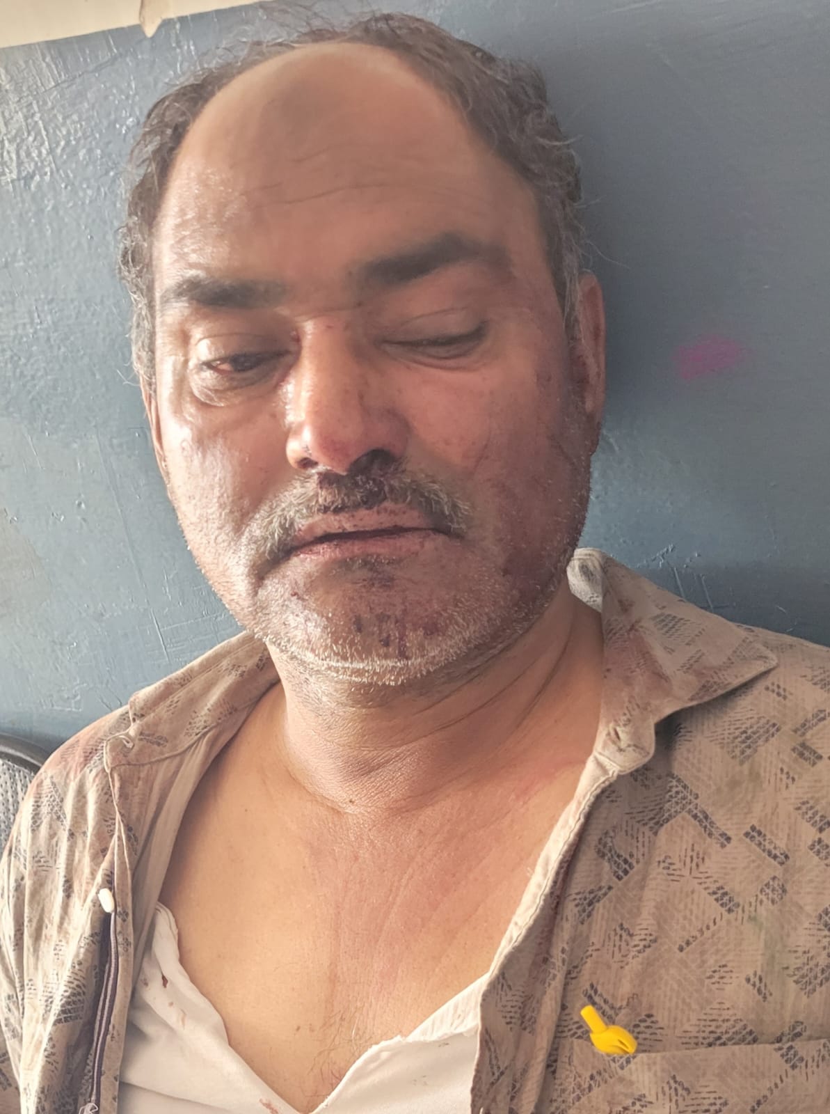 चिलकाना में हुई मारपीट का घायल चिलकाना में हुई मारपीट का घायल
