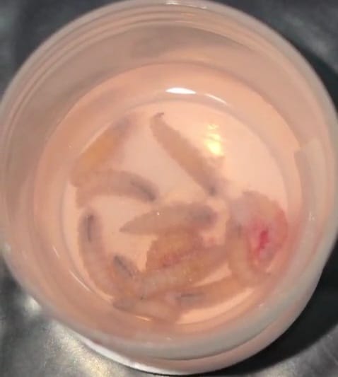 14 वर्षीय दिव्यांग बच्ची की नाक से एंडोस्कोपिक तकनीक से लार्वा निकालते डॉक्टर 14 वर्षीय दिव्यांग बच्ची की नाक से एंडोस्कोपिक तकनीक से लार्वा निकालते डॉक्टर