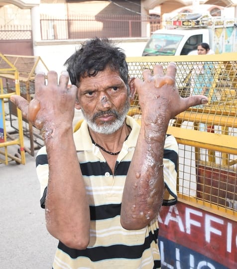 विकास नगर सेक्टर-12 में झुग्गी बस्ती में हुए अग्निकांड के दूसरे दिन कूछ ये रहे हालात।