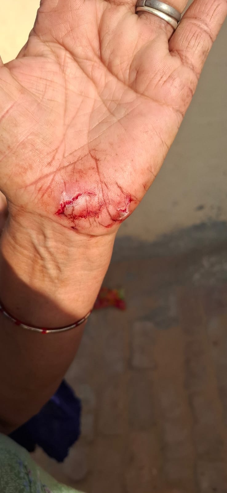 गांव थिलोड में लोमड़ी द्वारा पैर पर काटने का निशान दिखाती बुजुर्ग महिला।