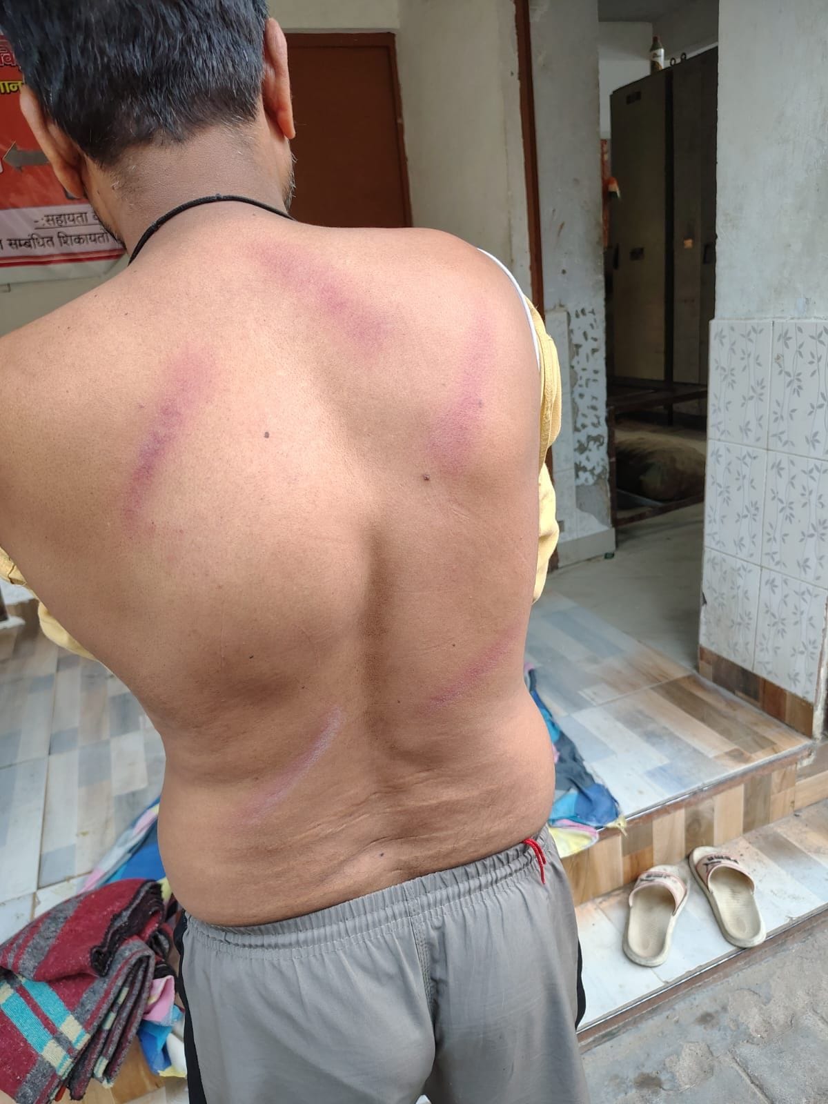 कर्मचारियों के पीट व पैर पर चोट के निशान और थाने पर एफआईआर दर्ज कराने पहुंचे कर्मचारी। कर्मचारियों के पीट व पैर पर चोट के निशान और थाने पर एफआईआर दर्ज कराने पहुंचे कर्मचारी।