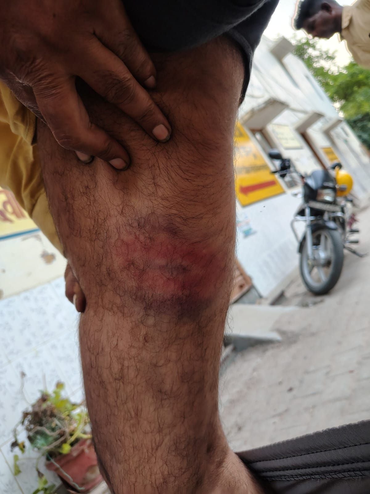 कर्मचारियों के पीट व पैर पर चोट के निशान और थाने पर एफआईआर दर्ज कराने पहुंचे कर्मचारी। कर्मचारियों के पीट व पैर पर चोट के निशान और थाने पर एफआईआर दर्ज कराने पहुंचे कर्मचारी।