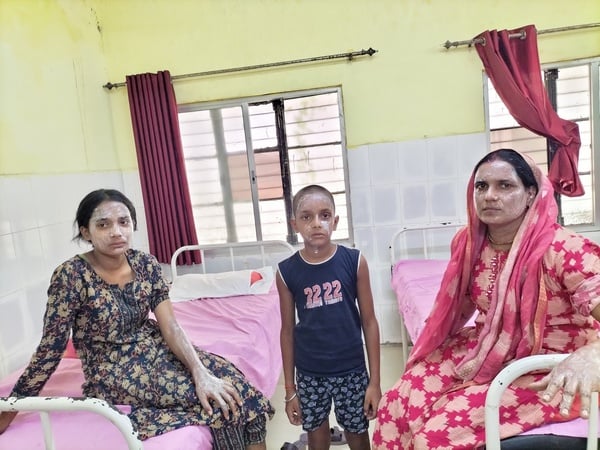 गैस सिलेंडर की पाइप में लीकेज होने से लगी आग से झुलसे प्रदीप यादव का चल रही इलाज।स्रोत-सोशल मीड
