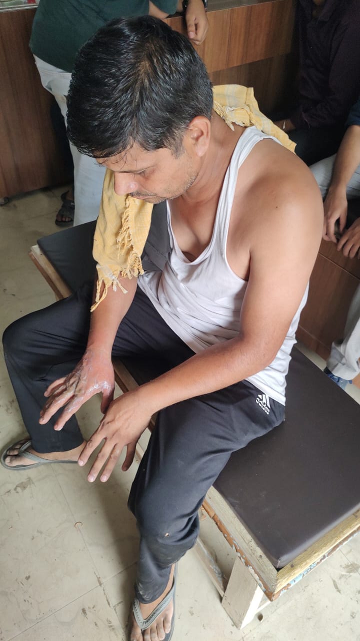 शारदा रोड पर हाईटेंशन लाइन पर काम करते हुए झुलसा हुआ लाइनमैन योगेंद्र। स्रोत : विभाग। शारदा रोड पर हाईटेंशन लाइन पर काम करते हुए झुलसा हुआ लाइनमैन योगेंद्र। स्रोत : विभाग।