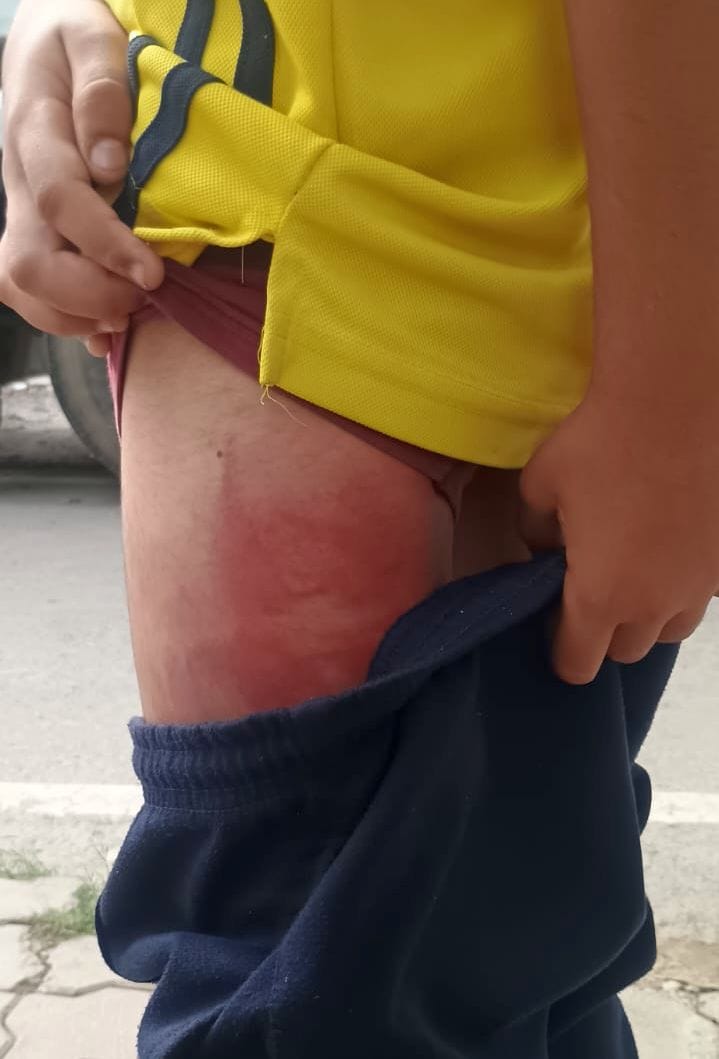 स्कूल और छात्र के पैर पर पिटाई के निशान। स्कूल और छात्र के पैर पर पिटाई के निशान।
