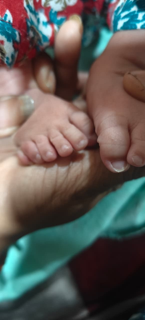 पालमपुर अस्पताल में हाथ और पैरों की छह-छह उंगलियों वाली बच्ची। -स्रोत ः स्वास्थ्य विभाग