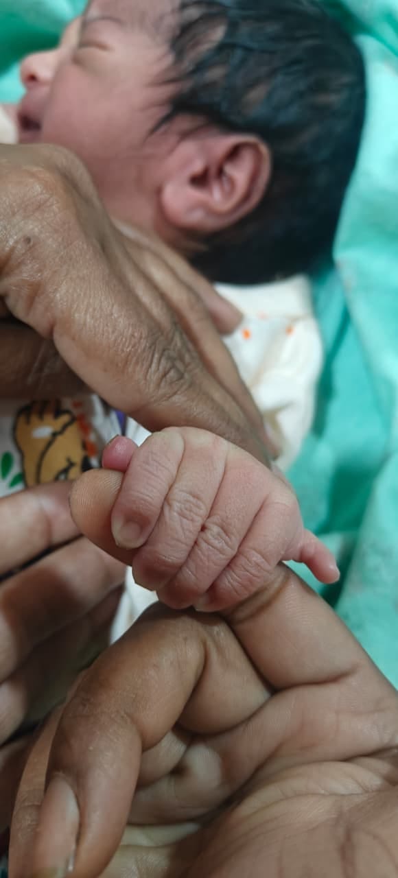 पालमपुर अस्पताल में हाथ और पैरों की छह-छह उंगलियों वाली बच्ची। -स्रोत ः स्वास्थ्य विभाग