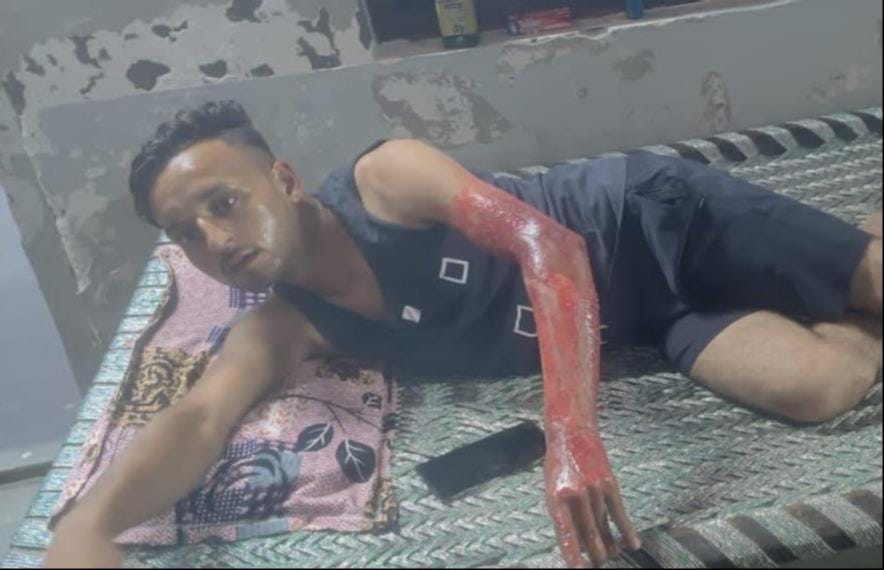 झिंझाना के बिडौली सादात में रेफ्रिजेरेटर का कंप्रेसर फटने से लगी आग में झुलसा युवक। संवाद झिंझाना के बिडौली सादात में रेफ्रिजेरेटर का कंप्रेसर फटने से लगी आग में झुलसा युवक। संवाद