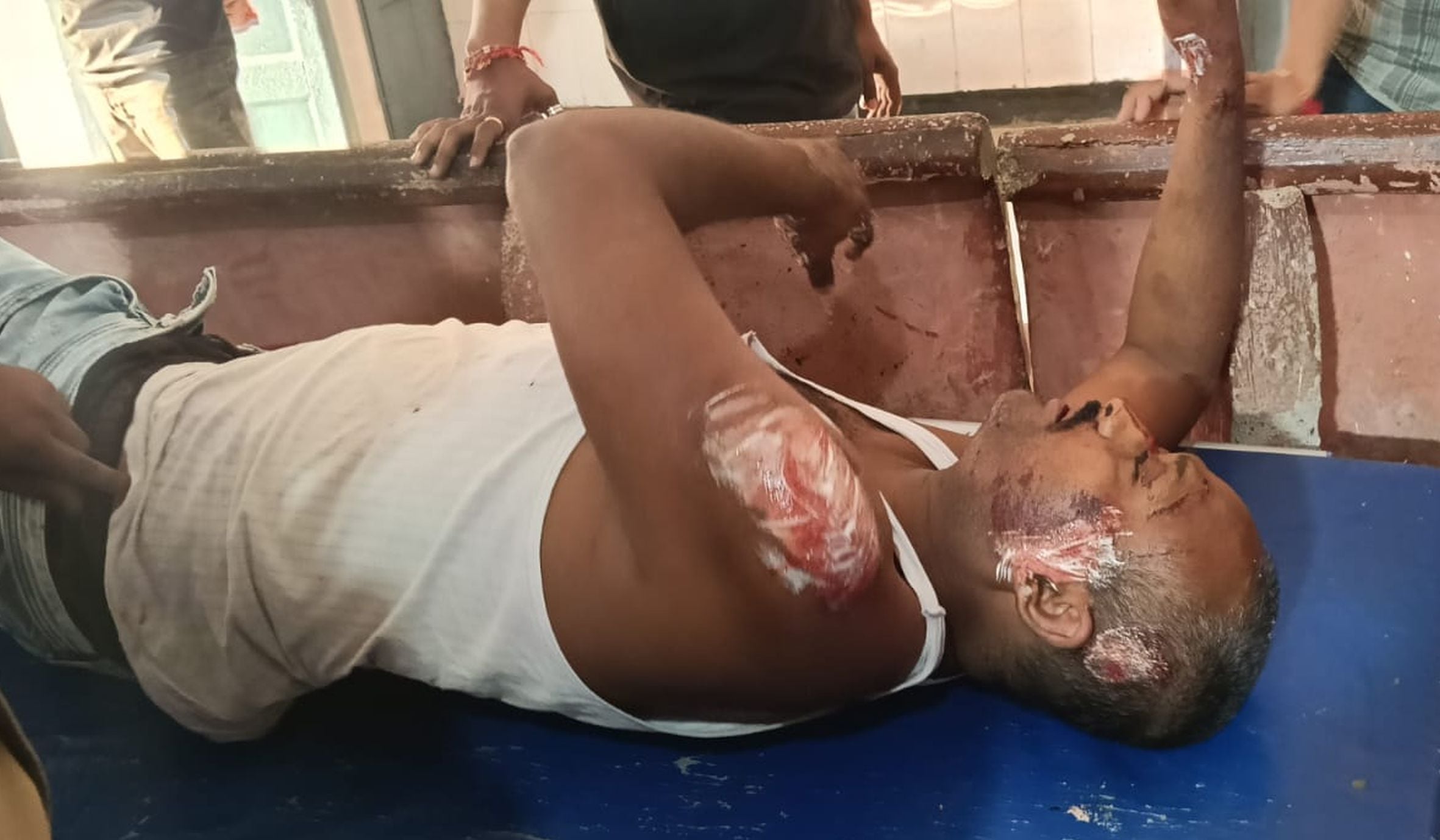 लालगंज सीएचसी में इलाज कराती सड़क हादसे में घायल बालिका। लालगंज सीएचसी में इलाज कराती सड़क हादसे में घायल बालिका।