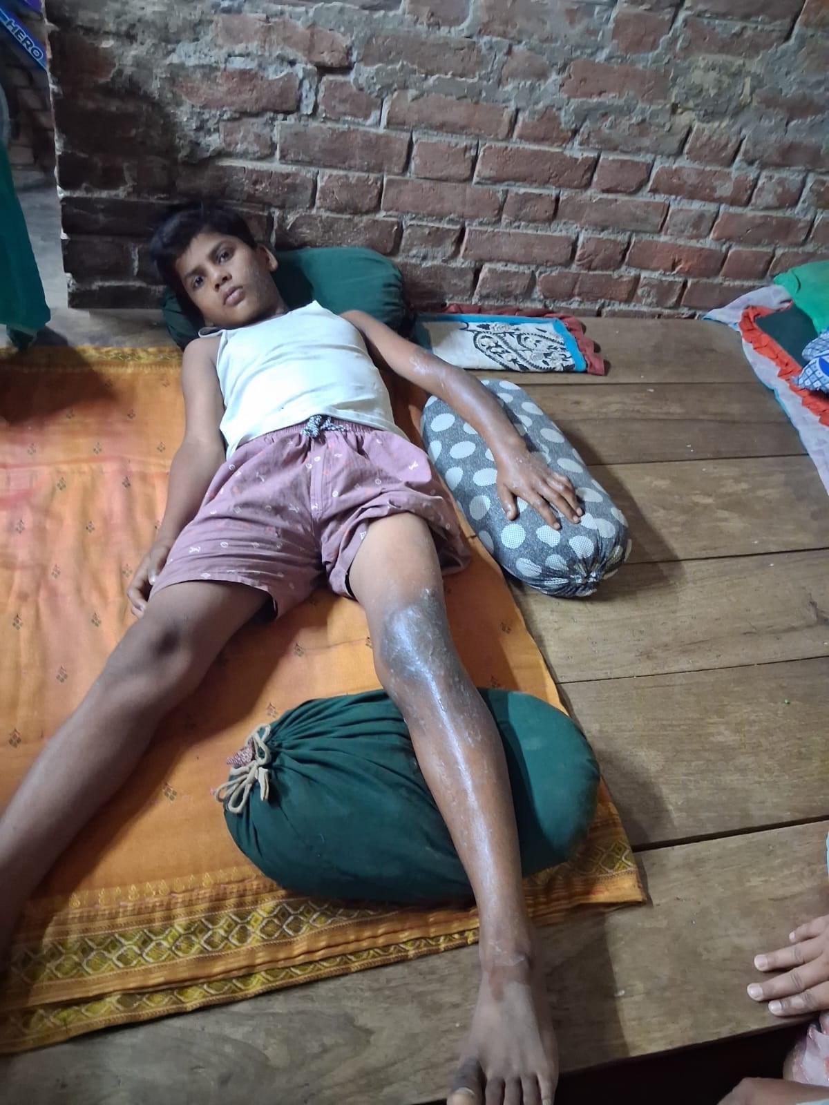 ट्रॉमा में भर्ती करंट लगने से झुलसा रहमत अली।  