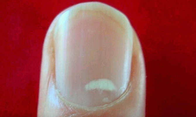 the-real-reason-behind-the-white-marks-on-your-nails