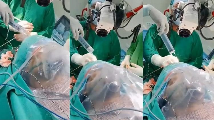 Brain tumor surgery: The patient sang ghazal during brain tumor surgery, the video of the live operation is going viral