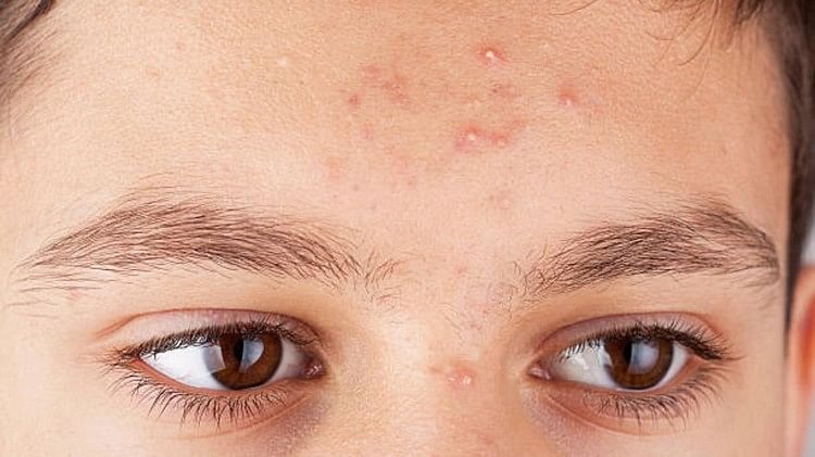Home Remedies For Forehead Bumps