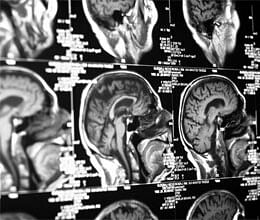 Brain ultrasound may boost mood: study